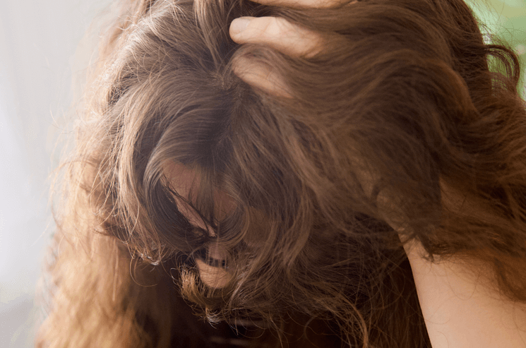 Dandruff Remedies
