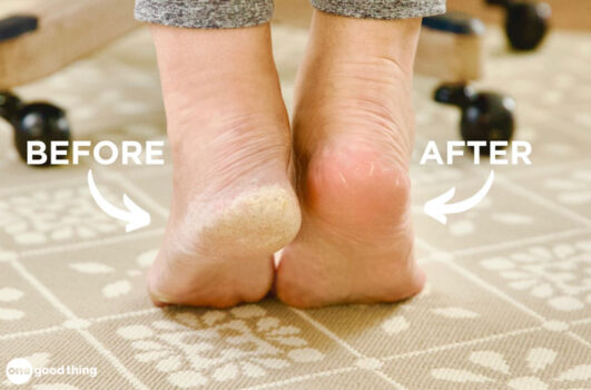 before and after of woman's heels with an exfoliating foot peel