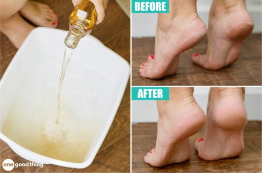 A Listerine and vinegar foot soak works wonders on dry feet and heels!