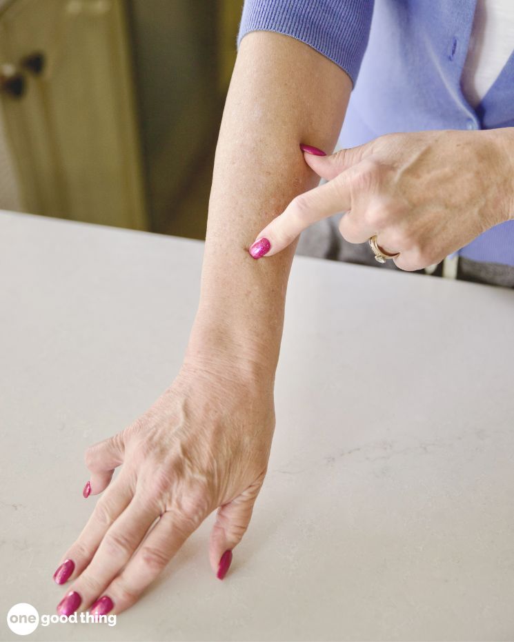 A person with painted nails points to mosquito bites on their forearm while standing at a countertop.